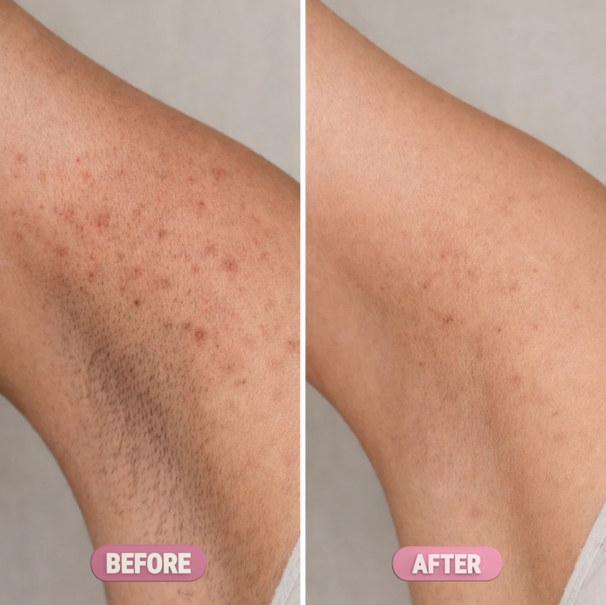 Ezvara™ Hair Reduction Oil