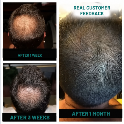 Ezvara™ Minoxidil 5% Scalp Cream