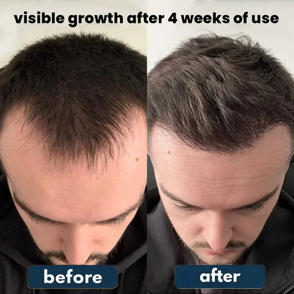 Ezvara™ Hair Growth Roll-On