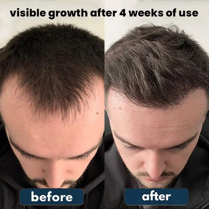 Ezvara™ Hair Growth Roll-On