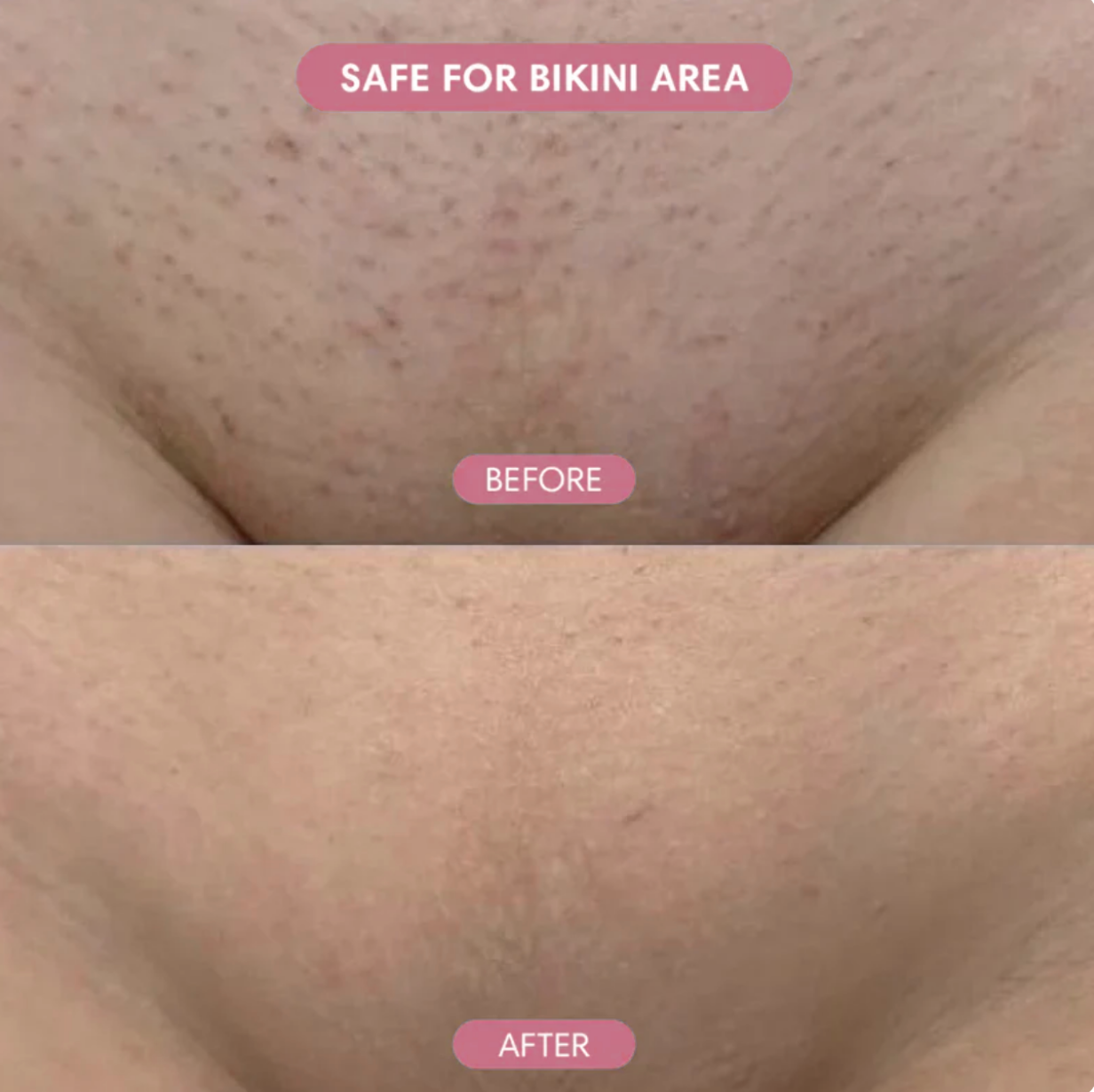Ezvara™ Hair Reduction Oil