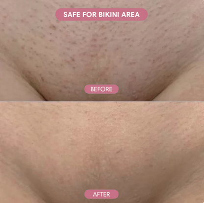 Ezvara™ Hair Reduction Oil